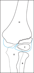 Fracture_Lateral condyle_Figure 2_1101127-Lateral_Condyle_AP_drawing.jpg